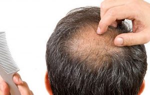 محققان : یک نوشیدنی پرمصرف باعث ریزش موی زودرس می‌شود